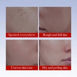 SADOER Anti Freckle Cream Face Whitening Creams Spot Removing Anti-aging Moisturizing Freckles Removal Facial Cream Skin Care Beto Beauty