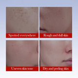 SADOER Anti Freckle Cream Face Whitening Creams Spot Removing Anti-aging Moisturizing Freckles Removal Facial Cream Skin Care Beto Beauty